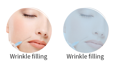 Wrinkle filling