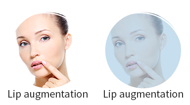 Lip augmentation